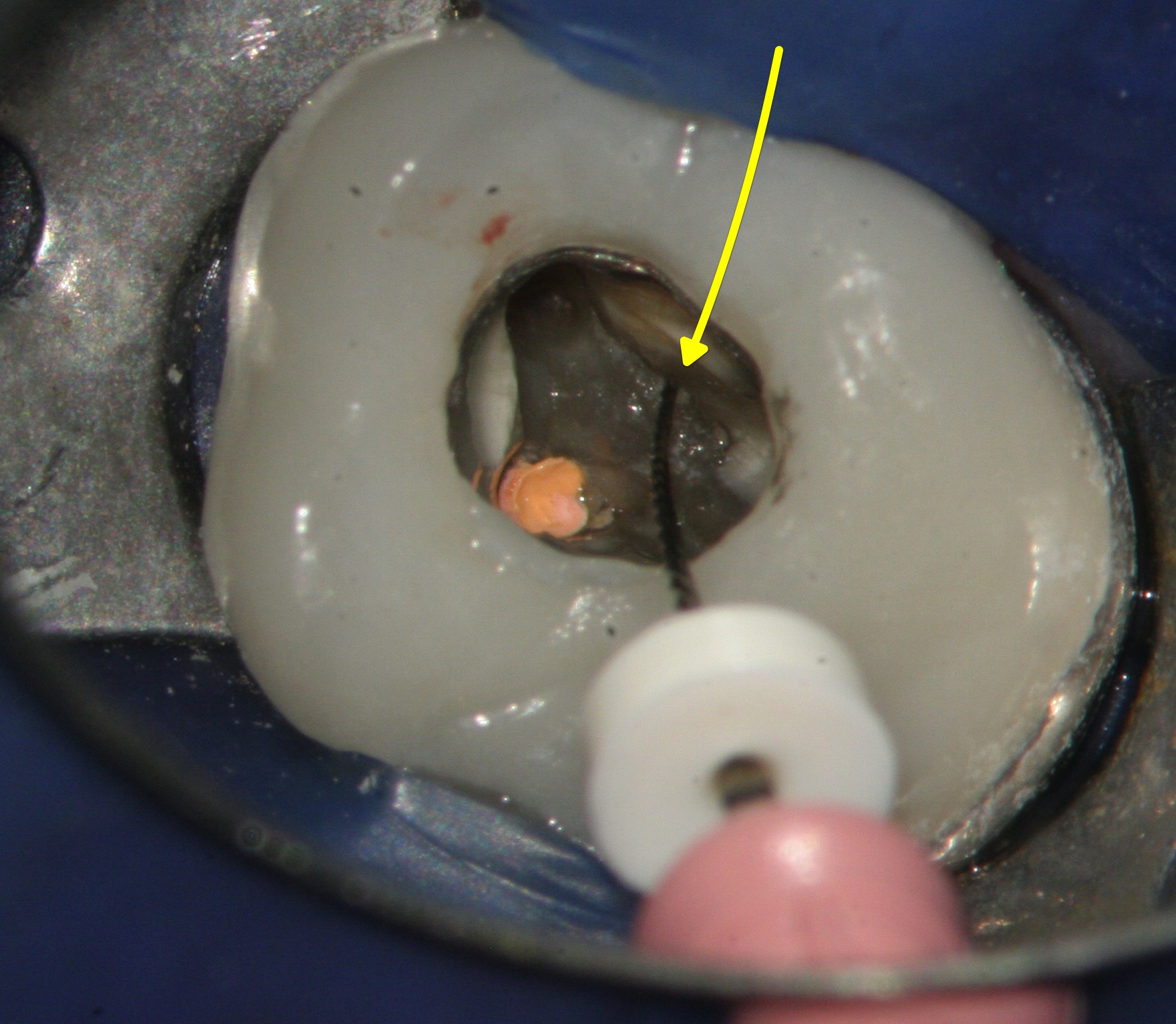 1325959994_4. Smallest endodontic file in previously missed MB2 canal